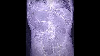 Sigmoid volvulus  typical case CT findings [upl. by Sauls]