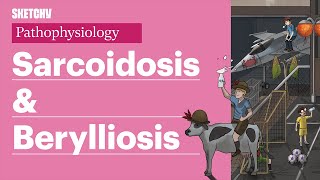 Sarcoidosis Pathophysiology Part 1  Sketchy Medical  USMLE Step 1 [upl. by Areema918]