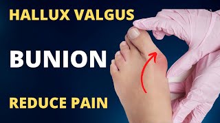 Hallux Valgus Treatment without Surgery [upl. by Newel]