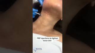 PRP Plateletrich plasma treatment prp prptreatment sugarland houstontx medspa skincare [upl. by Ydisac]