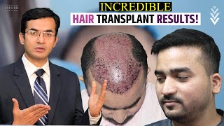 Incredible Hair Transplant Results in India at Medispa India by Dr Suneet Soni [upl. by Dressler]