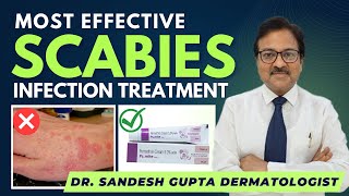 Scabies Treatment Dr Sandesh Gupta Dermatologist Delhi9990804089 [upl. by Eelorac260]