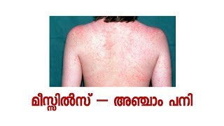 UNDERSTAND MEASLES  a small videos [upl. by Nylime949]