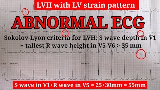 ECG Learn about STRAIN PATTERN  Very important topic [upl. by Acina904]