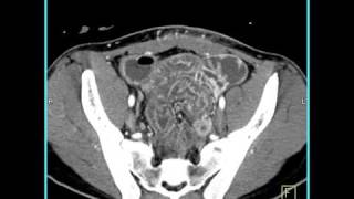 Abdomen Small Bowel EnteritisSeries of coronal sagittal volume rendered and MIP images4 of 6 [upl. by Ainej]