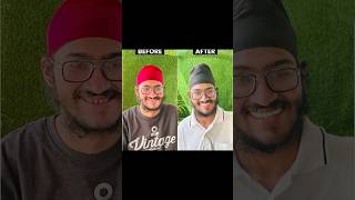 Dental Fluorosis  Smile Designing Treatment shorts viralvideo shorts smilemakeover dental [upl. by Verdha]