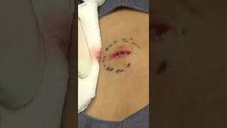 Watch Js story then click over to watch the full procedure Click below to watch drpimplepopper [upl. by Labana]