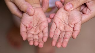 Hand Foot and Mouth Disease  Akron Childrens Hospital video [upl. by Crosley734]