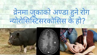 Neurocysticercosis in Nepali doctor sathi [upl. by Bren763]