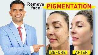 Remove Face Pigmentation Naturally  Melasma  Get Rid Of Melasma pigmentation and Dark Spots [upl. by Herriott]