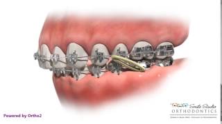 Elastics  Class II  Orthodontic Treatment [upl. by Ardys]