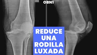 RODILLA LUXADA O DISLOCADA  APRENDE A REDUCIRLA [upl. by Dippold]