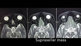 Suprasellar mass Craniophyryngioma Pterional Craniotomy Dr Akshay Vijay Kulkarni MCH [upl. by Yesnnyl]