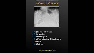 Radiographic signs of pulmonary edema  mnemonic [upl. by Areemas590]