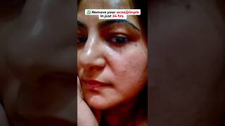 ⭕Remove Your AcnePimple in Just 24Hrs 😱 pimple acne skincare simranskincare [upl. by Sherburn]