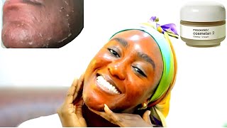 COSMELAN PEEL on Black Skin for Hyperpigmentation and Acne Scars  Full Peeling Process  Review [upl. by Cheney]