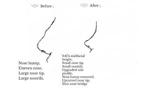 “ ᵛⁱʳᵗᵘᵃˡ ⁿᵒˢᵉ ˢᵘʳᵍᵉʳʸ “  Nose reconstruction subliminal ♡¸• Ultra Effective 🍥 [upl. by Nylak]