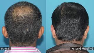 Crown hair transplant in India  Eugenix Hair Transplant Sciences [upl. by Dove483]