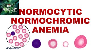 NORMOCYTIC NORMOCHROMIC ANEMIA Causes Mechanism amp Approach [upl. by Arais]