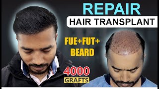 REPAIR Hair Transplant Results at Medispa Hair Transplant India  Best Cost  Best Result [upl. by Gamali]