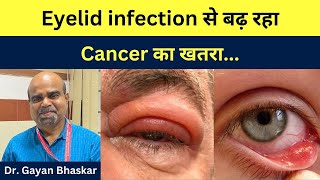 EYELID INFECTION से बढ़ रहा Cancer का खतरा। Dr Gayan Bhaskar । [upl. by Wellington]