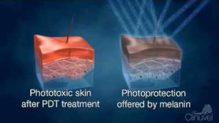 Clinuvel improving quality of life  Photodynamic Therapy PDT [upl. by Byram]