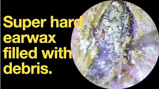 Super hard earwax filled with debris ear wax removal  ear cleaning  ASMR  relaxation  relax [upl. by Oman]