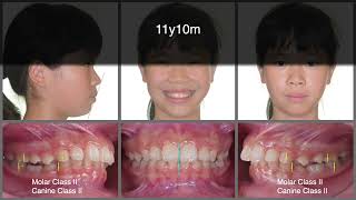 Solving Overjet and Deepbite with Aligners  Part 1｜【Chris Chang Ortho】CC819 [upl. by Ennairda]