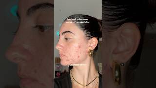 PRO MAKEUP TRANSFORMATION ON ACNETEXTURED SKIN 😍 [upl. by Alehs]