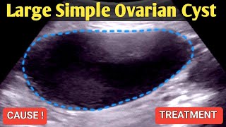 Large Simple Ovarian Cyst  Ultrasound [upl. by Marylinda132]