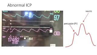 ICP Monitoring for Neurosurgery Residents [upl. by Solly626]