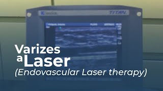 Varizes a Laser Endovascular Laser Therapy [upl. by Rog]