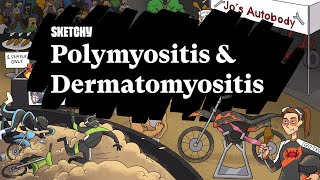 Path Study Guide Polymyositis amp Dermatomyositis  Sketchy Medical  USMLE Step 1 [upl. by Ynnaej]