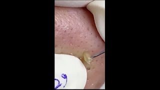 WHITEHEADS REMOVAL NOSE SATISFYING NOSE BLACKHEAD NOSE BLACKHEAD REMOVAL blackhead noseblackhead [upl. by Akoyn]