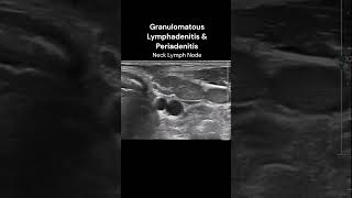 Neck Lymph Nodes  4 ultrasound imaging infection inflammation cases [upl. by Happy192]