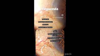 Pinguecula  Sign  Symptoms  Treatment  Optometry Solutions [upl. by Redan241]