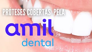 Quais Próteses são cobertas pela Amil Dental E170E90 e E60 [upl. by Lletnuahs]