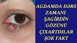 Ağdam prokurorluğu niyə işə baxmırŞagirdin gözünü kor edən şəxs himayə olunur [upl. by Naired]