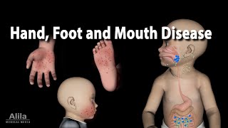 Hand Foot and Mouth Disease Animation [upl. by Novyart]