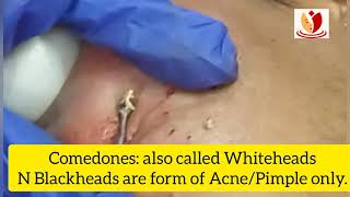 ComedonesWhiteheads and Blackheads removal treatment by comedone extractor Results before n after [upl. by Marylee]