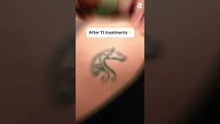 Before amp After Tattoo Removal at Removery🤩 [upl. by Leahcimaj]