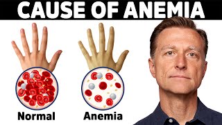 The Hidden Cause of Anemia Youve Never Heard About [upl. by Martguerita754]