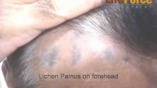 Lichen Planus on scalp treated using homeopathy by Dr Rajesh Shah MD [upl. by Alegnatal]