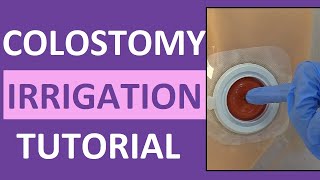 Colostomy Irrigation Procedure Care  Ostomy Enema Nursing  Stoma Cleaning [upl. by Terra]