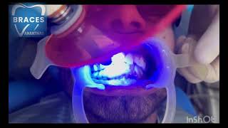 CLASS 2 DIV 1 MALOCCLUSION  BRACES  ORTHODONTICS trending dentist toothdental dentalcare [upl. by Elmajian]