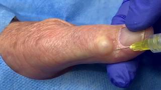 Ganglion Cyst Jelly Doughnut Hole Extraction [upl. by Imer]