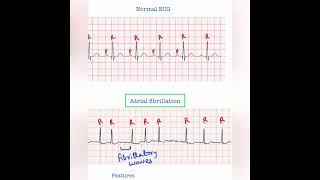 Atrial fibrillation ECG  USMLE Step 1 amp 2 [upl. by Lodovico480]