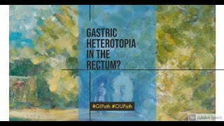 Gastric Heterotopia [upl. by Ereveniug199]