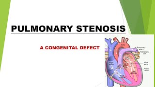 Pulmonary Stenosis Congenital Defect NCLEXRNPrometric Preparation [upl. by Aibara809]