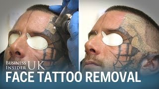 Watch This Man Have His Face Tattoo Removed From Laser Surgery  Business Insider [upl. by Aleunam]